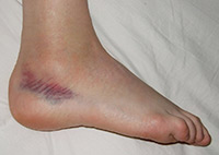sprained ankle with bruise