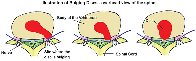 true sciatica, caused by a bulging disc