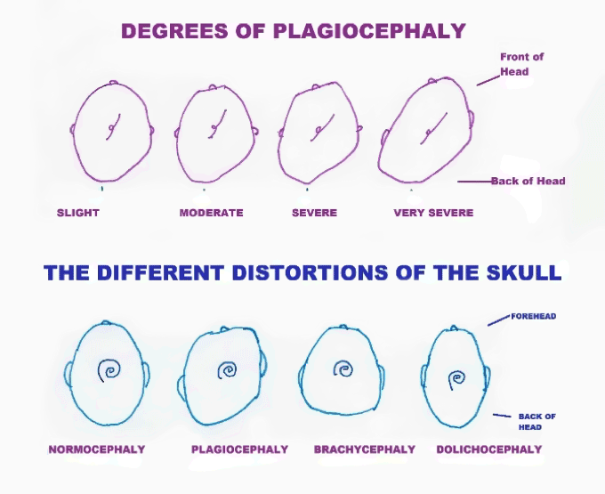 the different degrees of plagiocephaly
