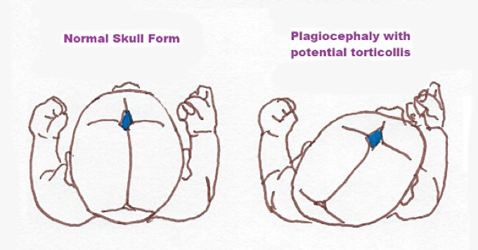 plagiocephaly with potential torticollis